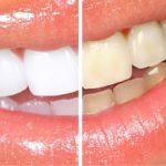 Потемнение эмали зубов
