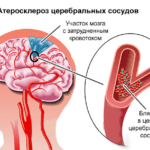 Атеросклероз церебрального типа