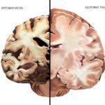 Атрофические изменения в тканях головного мозга