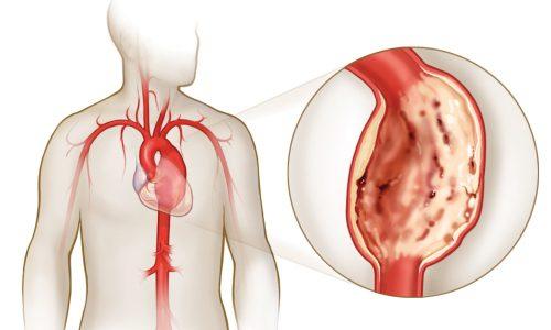 Перепады влияния потока крови на сосуды грудной