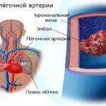 Эмболии артерии легких