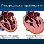 Гипертрофическая форма обструктивной кардиомиопатии