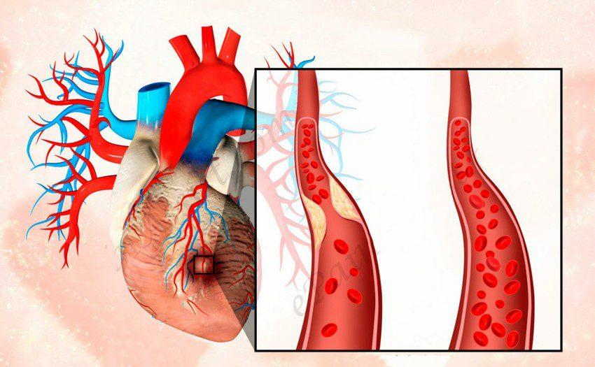 Хроническая и острая форма инфаркта