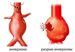 Классификация аневризмы сонной артерии