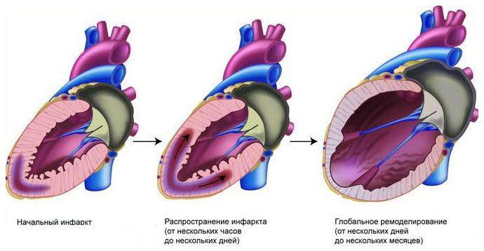 Нарушена работа сердечного желудочка слева после инфаркт