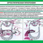 Ортостатическая гипотензия