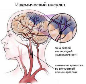 Отек мозга при ишемическом инсульте