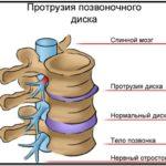 Есть ли связь между заболеваниями шейный остеохондроз и артериальное давление