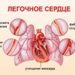 Синдром «легочного» сердца