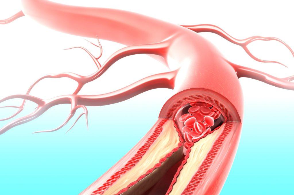 Стеноз почечной артерии