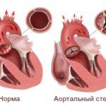 Стеноза клапана сердца