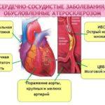 Тяжелые заболевания сердечно-сосудистой системы