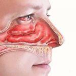 Воспаление слизистых носа