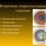 Вторичная глаукома