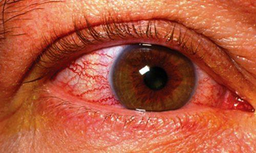Артерии сетчатки глаза сильно сужены