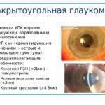 Закрытоугольного типа глаукома